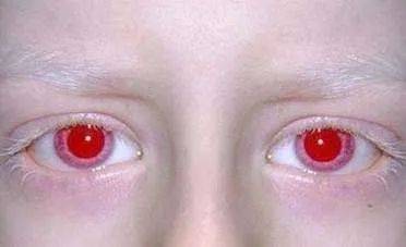 探秘双色瞳孔，遗传与变异的奇妙交织